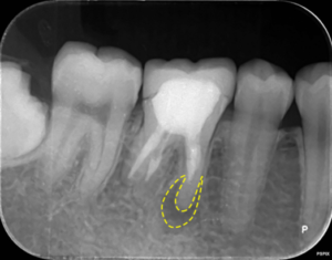 根管治療前